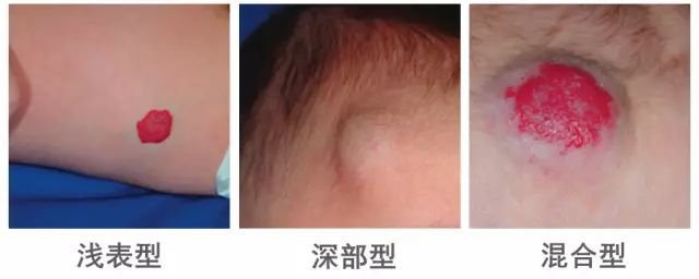 血管瘤，血管瘤区别，血管瘤危害