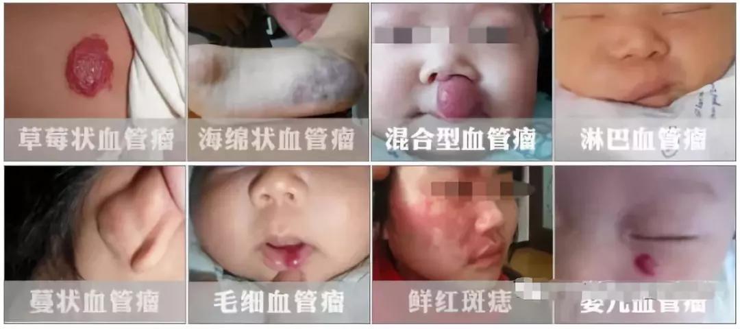 昆明血管瘤治疗，昆明血管瘤护理方法