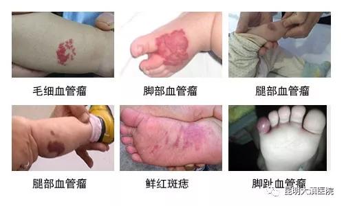 婴幼儿血管瘤，血管瘤分类，昆明治疗血管瘤