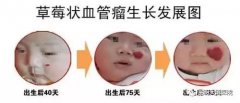 小红点,是否是血管瘤先兆
