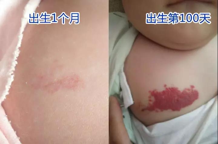 昆明血管瘤治疗，血管瘤危害