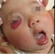 婴儿血管瘤为啥要早治疗