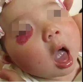 婴幼儿血管瘤