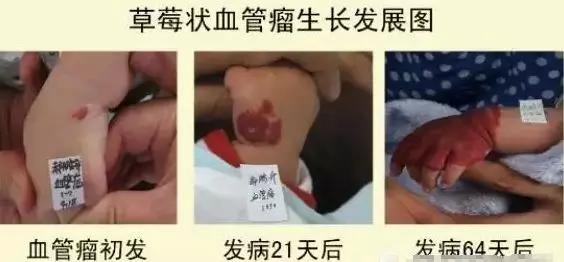 婴幼儿血管瘤生长