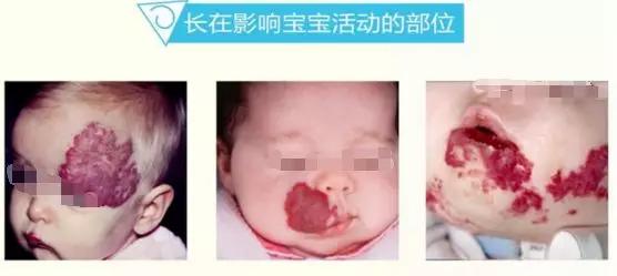 婴幼儿血管瘤治疗