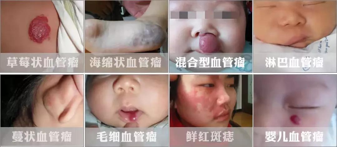 昆明血管瘤做哪些检查