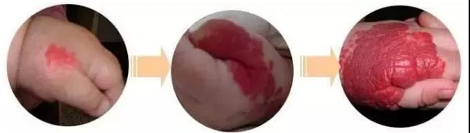 昆明血管瘤治疗