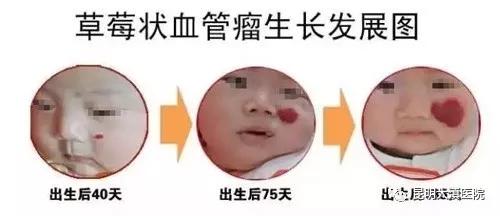 草莓状血管瘤
