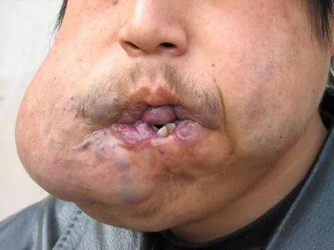 血管瘤治疗