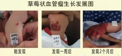 草莓状血管瘤