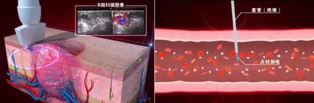 高频电凝微创治疗血管瘤