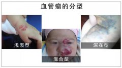 血管瘤解答|红斑就是血管