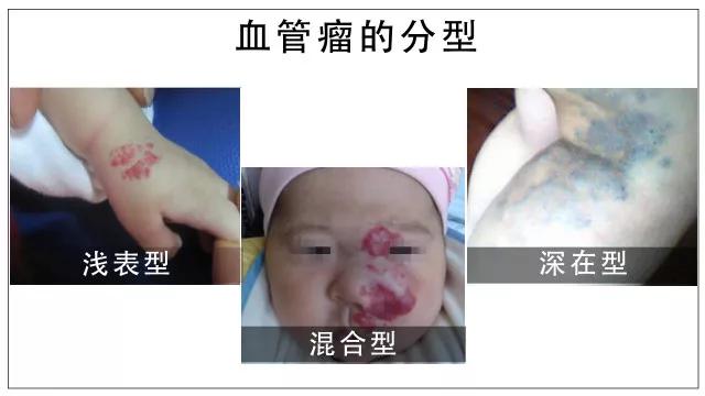 血管瘤的分型