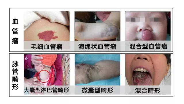 红斑是血管瘤吗