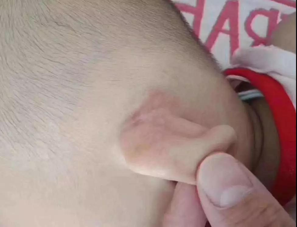 昆明大滇医院耳部血管瘤治疗