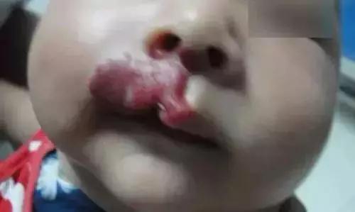 唇部血管瘤症状表现