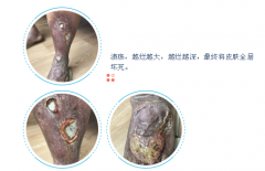 静脉曲张该怎么治