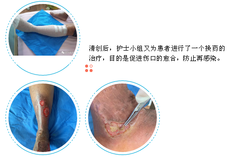 静脉曲张治疗