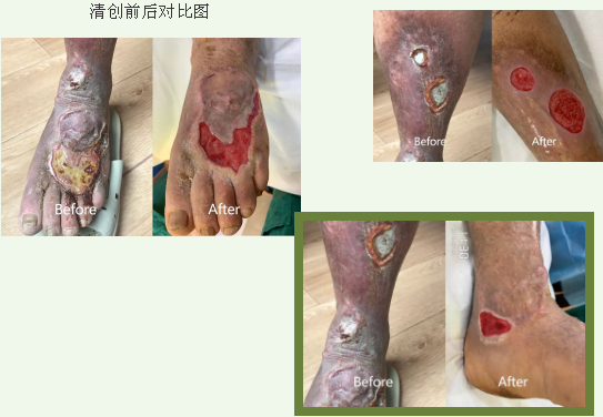 静脉性溃疡