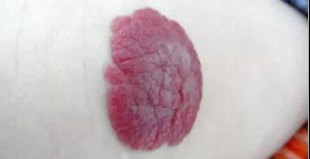 药膏一抹，就能消除血管瘤？