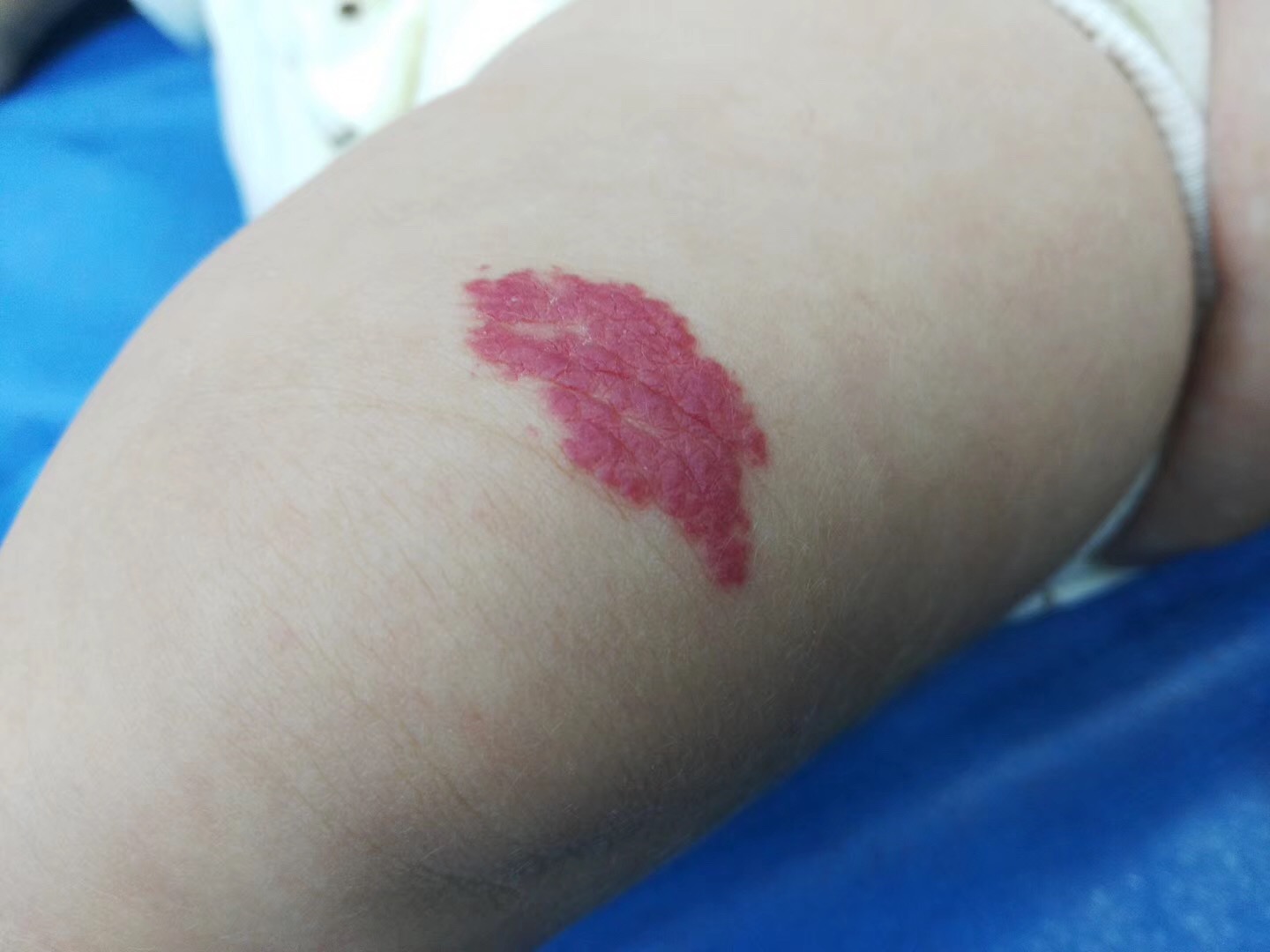 血管瘤宝宝