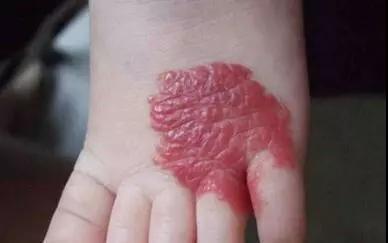 鲜红斑痣