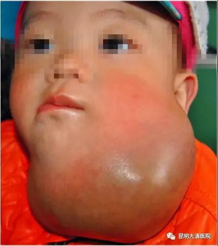 云南省“血管瘤与脉管畸形临床实习基地” 启动