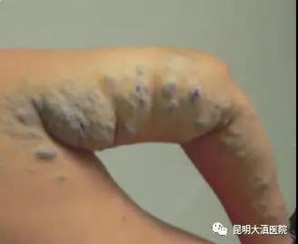 云南省“血管瘤与脉管畸形临床实习基地” 启动