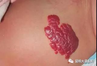云南省“血管瘤与脉管畸形临床实习基地” 启动